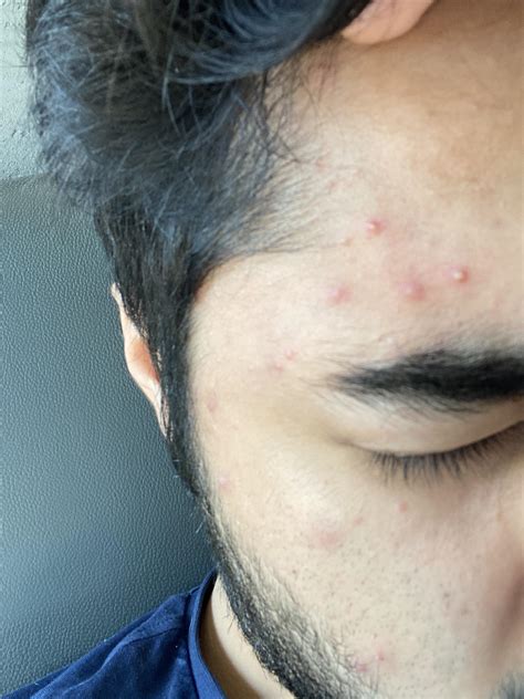 Skin Concern Not Sure Why But Ive Suddenly Started Developing Acne