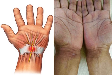 Carpal Tunnel Release Surgery Procedure And Benefits