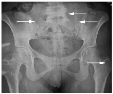 Pelvic X Ray Film Revealing A Bone Lesion White Arrows In Each