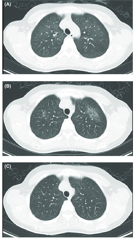 Computed Tomography Ct Imaging Of A Representative Example Of Delayed