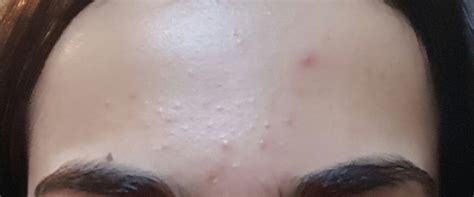 Forehead Bumps Candida Overgrowth Adult Acne Community