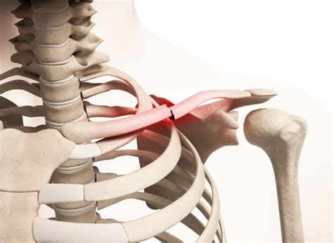 Clavicle Fracture Broken Collarbone Orthoinfo Aaos