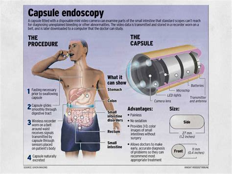 Video Capsule Endoscopy Procedure Cape Town Small Bowel Examination