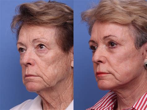 Facelift Before And After Pictures Case 295 Scottsdale Az Hobgood Facial Plastic Surgery