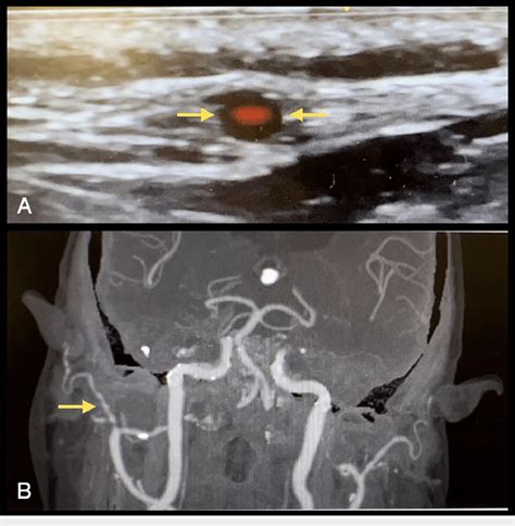 A Halo Sign Of The Superficial Temporal Artery In An 89 Yearold Man