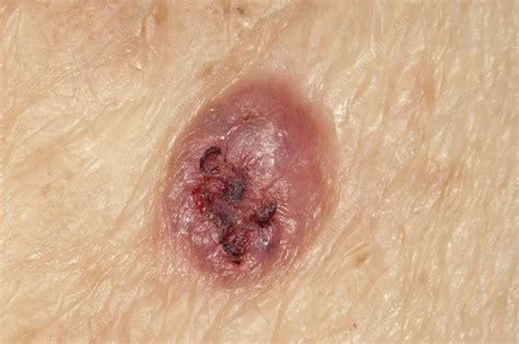 Basal Cell Skin Cancer On The Arm Stock Image C0117463 Science