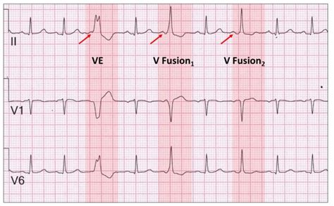 Exotic Ventricular Ectopy Part One Resources