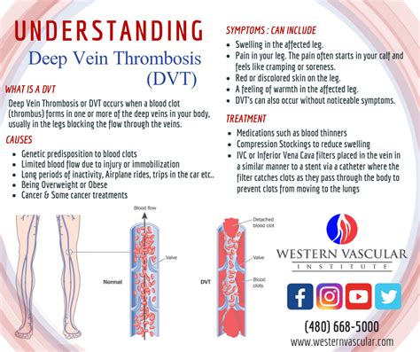 Understanding Deep Vein Thrombosis Dvt Western Vascular Institute