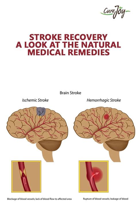 Stroke Recovery A Look At The Natural And Medical Remedies Stroke