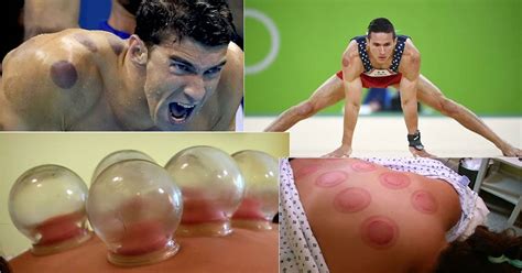 Cupping Therapy To Reduce Pain Boost Immunity And Improve Digestion