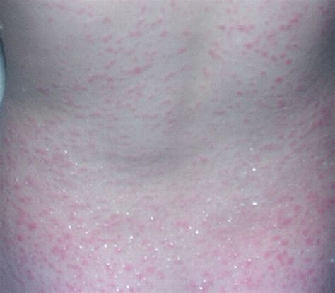 Scarlet Fever Pictures Symptoms Rash Contagious Treatment Causes