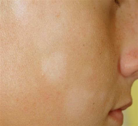 Pityriasis alba is a fairly common skin condition defined as dry hypo pigmented (less pigmented) patches on the face the exact cause of pityriasis alba is not known with certainty, however some. Pityriasis Alba - Pictures, Symptoms, Causes, Treatment