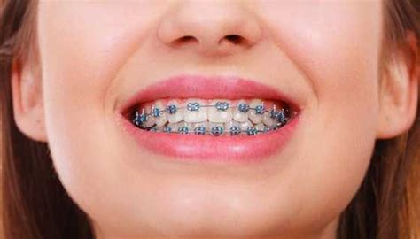 How Much Will It Cost For Metal Braces
