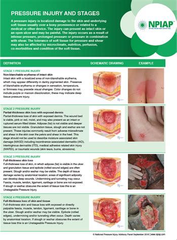 Pressure Ulcer Staging Guide