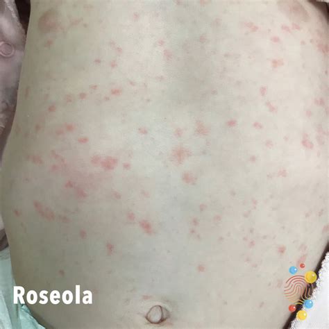 Roseola In Adults