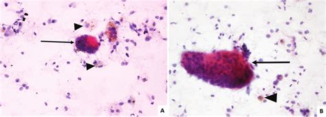 Cytological Findings Of Gctts With Dispersed Histiocyte Like Cells