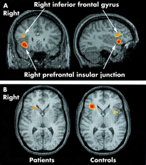 Concussion Brain Compared To Normal