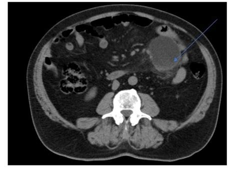 Cureus Lymphatic Mesenteric Cyst A Rare Cause Of Surgical Abdominal