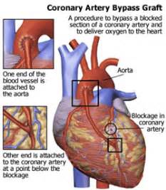 Coronary Artery Bypass Grafting Cabg Washington Regional Medical System