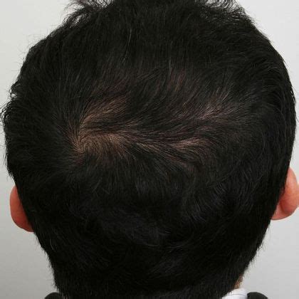 Crown Male Before And After Crown Hair Restoration Photos