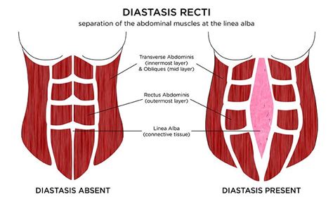 How To Check Yourself For Diastasis Recti Diary Of A Fit Mommy