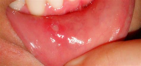 If you've ever had a mouth ulcer, you'll know they can be a pain. Best-Dental-Care-Mouth-Ulcer-Treatment-Medicine-In-KalyanNagar