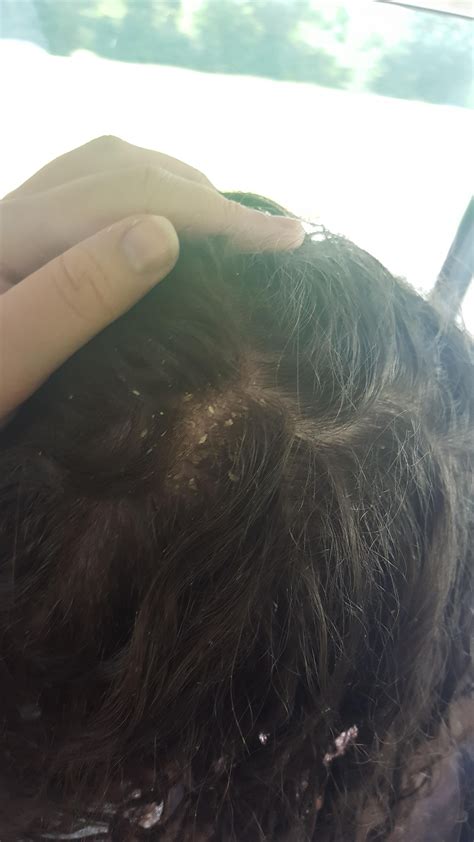 [Skin Concerns] My sister is suffering from severe dandruff and I'm not ...