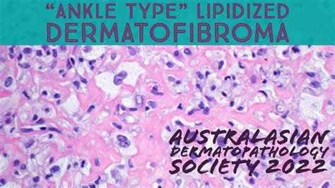Ankle Type Df Lipidized Dermatofibroma Pathology Dermpath