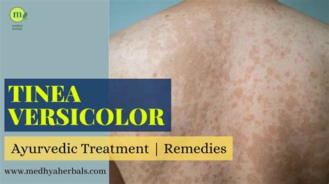 Tinea Versicolor Complete Ayurvedic Treatment That Will Cure Fast