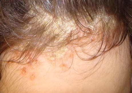Psoriasi del cuoio capelluto | Oghers