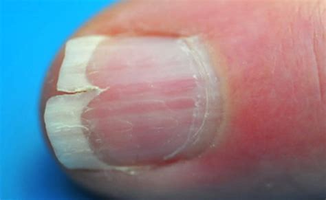 Split Fingernails Onychoschizia Symptoms Causes And Remedies