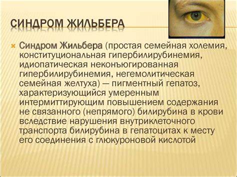 Синдром жильбера диета питание меню Болезнь Жильбера Симптомы И Лечение Диета — Похудение Диета Правильное Болезнь Жильбера Симптомы И Лечение Диета — Похудение Диета Правильное Синдром жильбера диета питание меню