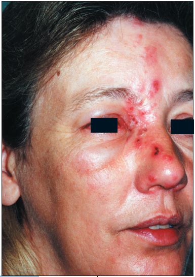 One of the main symptoms is a rash of blisters that doctors sometimes refer to as a herpes rash. Photoclinic: Herpes Zoster Ophthalmicus | Consultant360