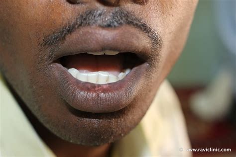 A Case Of Vitiligo On Lips Homeo Energy