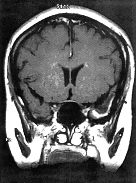 Fig 4 Idiopathic Hypertrophic Cranial Pachymeningitis Case Report