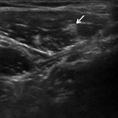 Ultrasound Image Of The Lateral Femoral Cutaneous Nerve Arrow Figure
