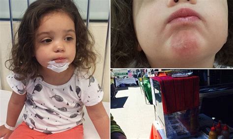 Girl Suffers Burns From A Pie Warmer At Sydneys Orange Grove Markets