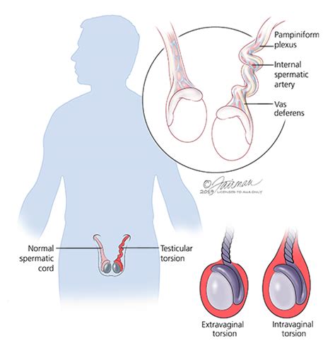 Testicular Torsion Symptoms Diagnosis Treatment Urology Care Foundation