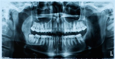 Panoramic Dental X Ray Keller Dentistry
