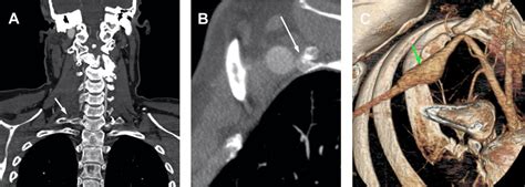 Imaging Assessment Of Thoracic Outlet Syndrome Thoracic Key