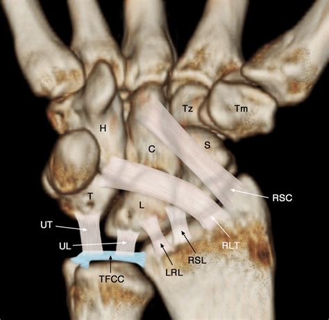 It attaches to the base of the second and third hand 3 extensor carpi ulnaris: Schematic diagram of volar extrinsic wrist ligaments. RSC ...
