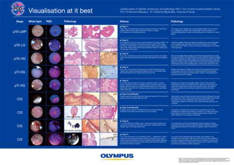 Photodynamic Diagnosis For Nmibc Poster Olympus Professional Education On Demand Library