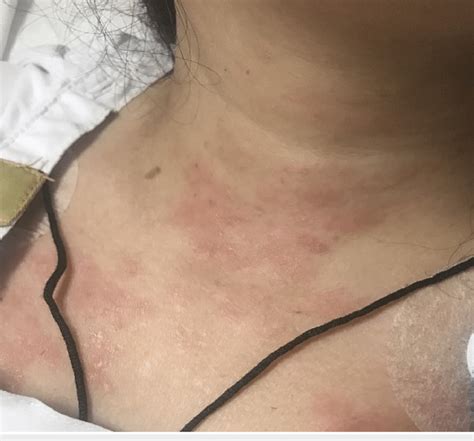 A Maculopapular Rash Is Visible Over The Neck And The Upper Trunk The