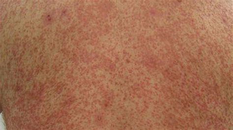 Purpura Causes Diagnosis Treatments And Pictures