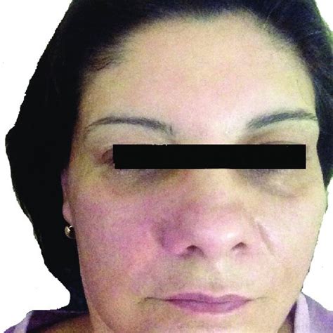 Swelling And Mild Redness Is Seen Of The Right Nasolabial Fold
