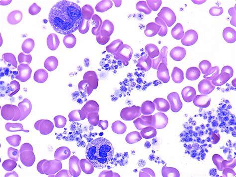 Thrombocytosis Definition Causes Symptoms Diagnosis Treatment