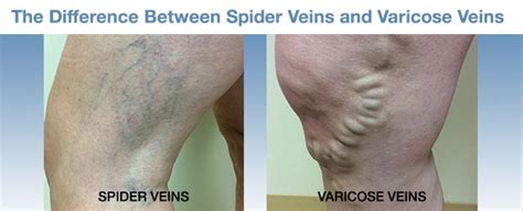 Difference Between Spider Veins And Varicose Veins Avcc