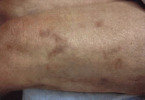Pruritic Indurated Plaques On The Legs Of A 62 Year Old Woman—quiz Case