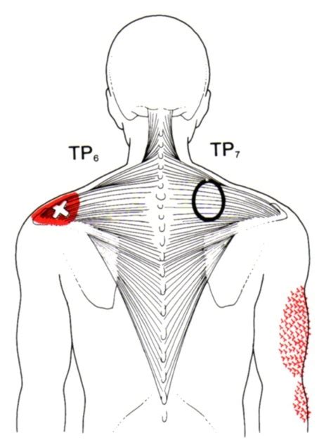 Trapezius The Trigger Point And Referred Pain Guide