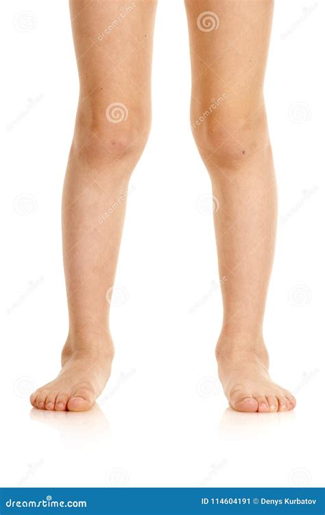 Valgus Deformity Of Legs Stock Image Image Of Closeup 114604191